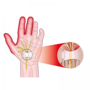 Le Syndrome Du Canal Carpien Dr Kilinc Chirurgien Orthop Diste