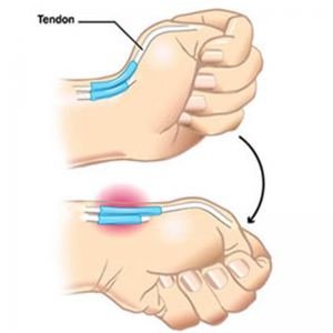 tendon - poignet et main