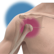 Luxation-epaule-illustration-Dr-Kilinc-institut-epaule-paris-Jouvenet