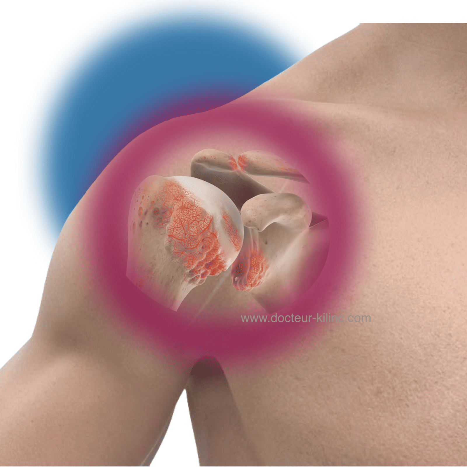 arthrose centree et excentrée de l'épaule