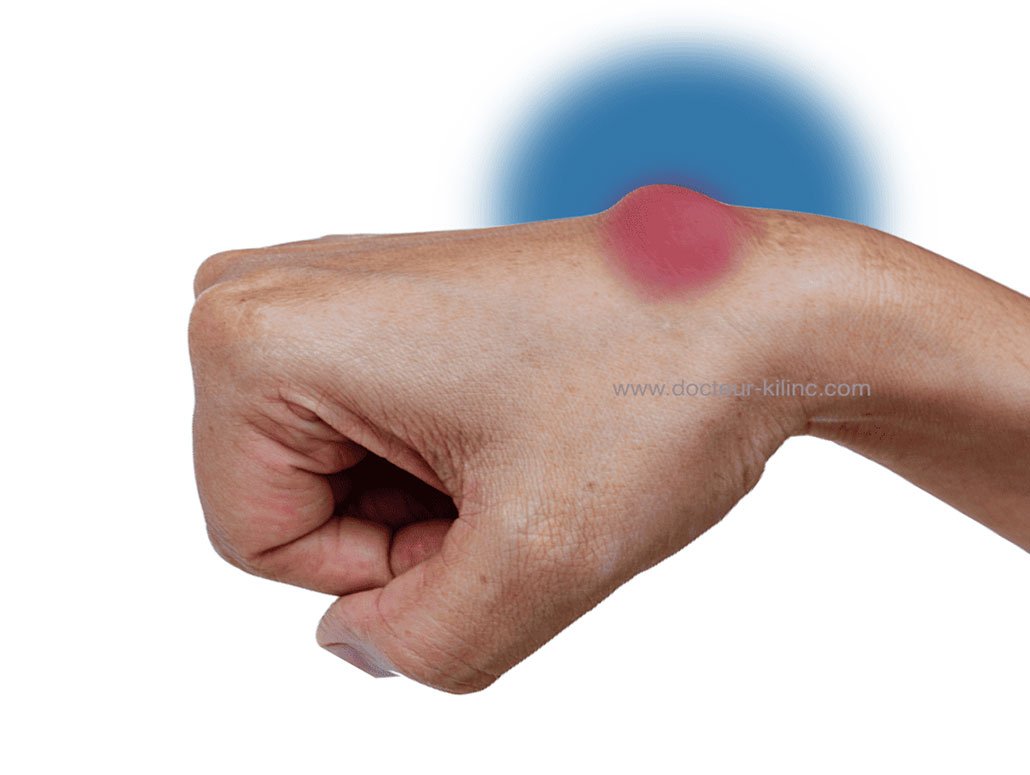 Kyste synovial de la main | Dr Kilinc Chirurgien de la main Paris 16