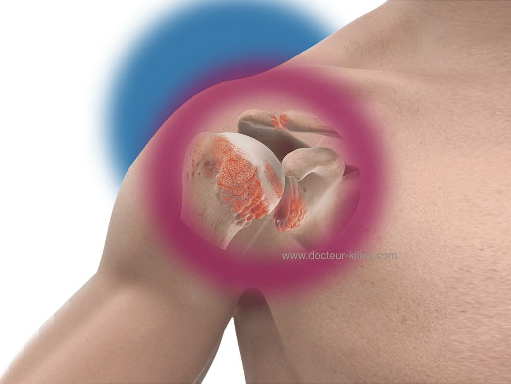 Définition, symptômes et diagnostic de l'arthrose de l'épaule