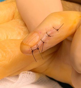 Tumeur glomique doigt symptôme, cause, traitement chirurgie main