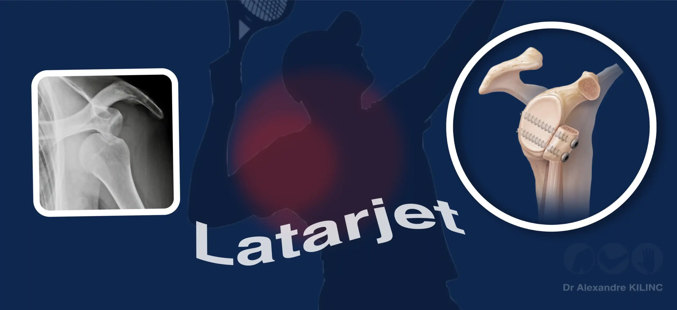Intervention de Latarjet Paris - Dr Kilinc
