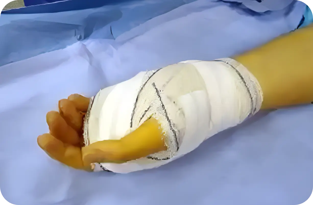 Pansement canal carpien endoscopique echograpique Dr Kilinc Pansement après opération du canal carpien echographique endoscopique video institut maiin paris jouvenet