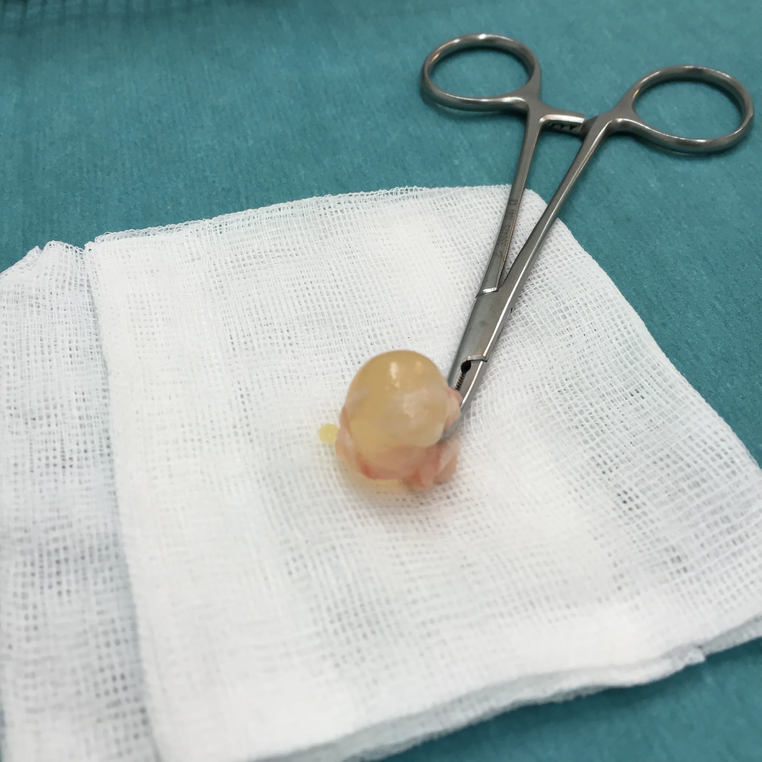 Aspect Kyste synovial Dr Kilinc Aspect du kyste synovial