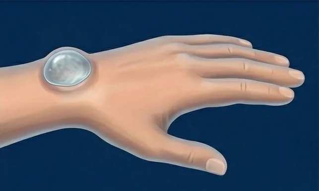 Kyste synovial contenu liquidien Kyste synovial dorsal du poignet : poche de liquide reliée à l'articulation
