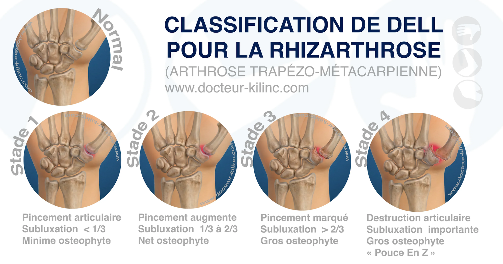 Classification de Dell de la rhizarthrose : stades 1 à 4 de l'arthrose trapézo-métacarpienne Classification de Dell de la rhizarthrose : stades 1 à 4 de l'arthrose trapézo-métacarpienne