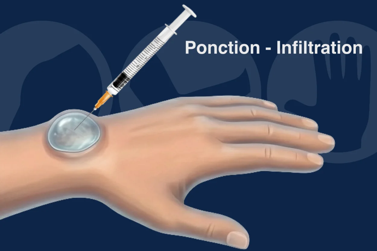 Ponction kyste synovial ponction kyste