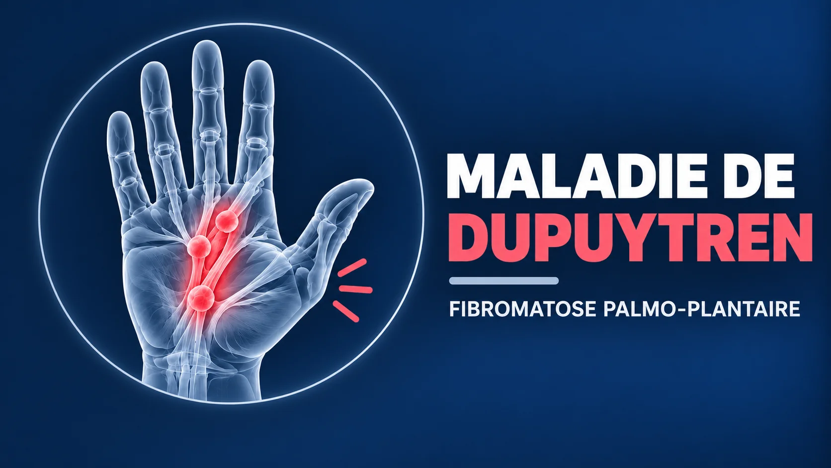 Vignette - Dr Kilinc - Dupuytren Maladie de Dupuytren