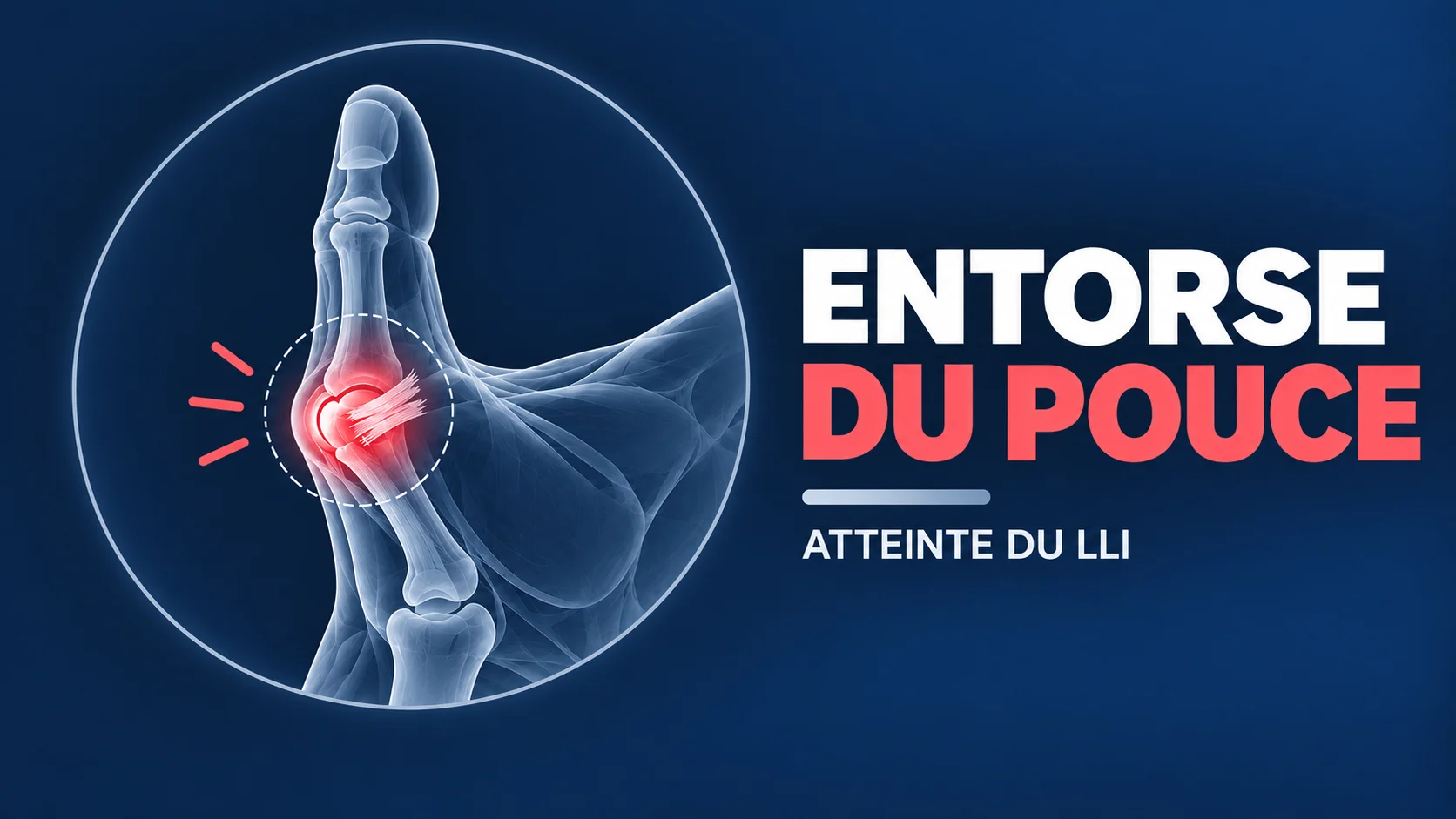 Vignette - Dr Kilinc - Entorse LLI pouce entorse pouce