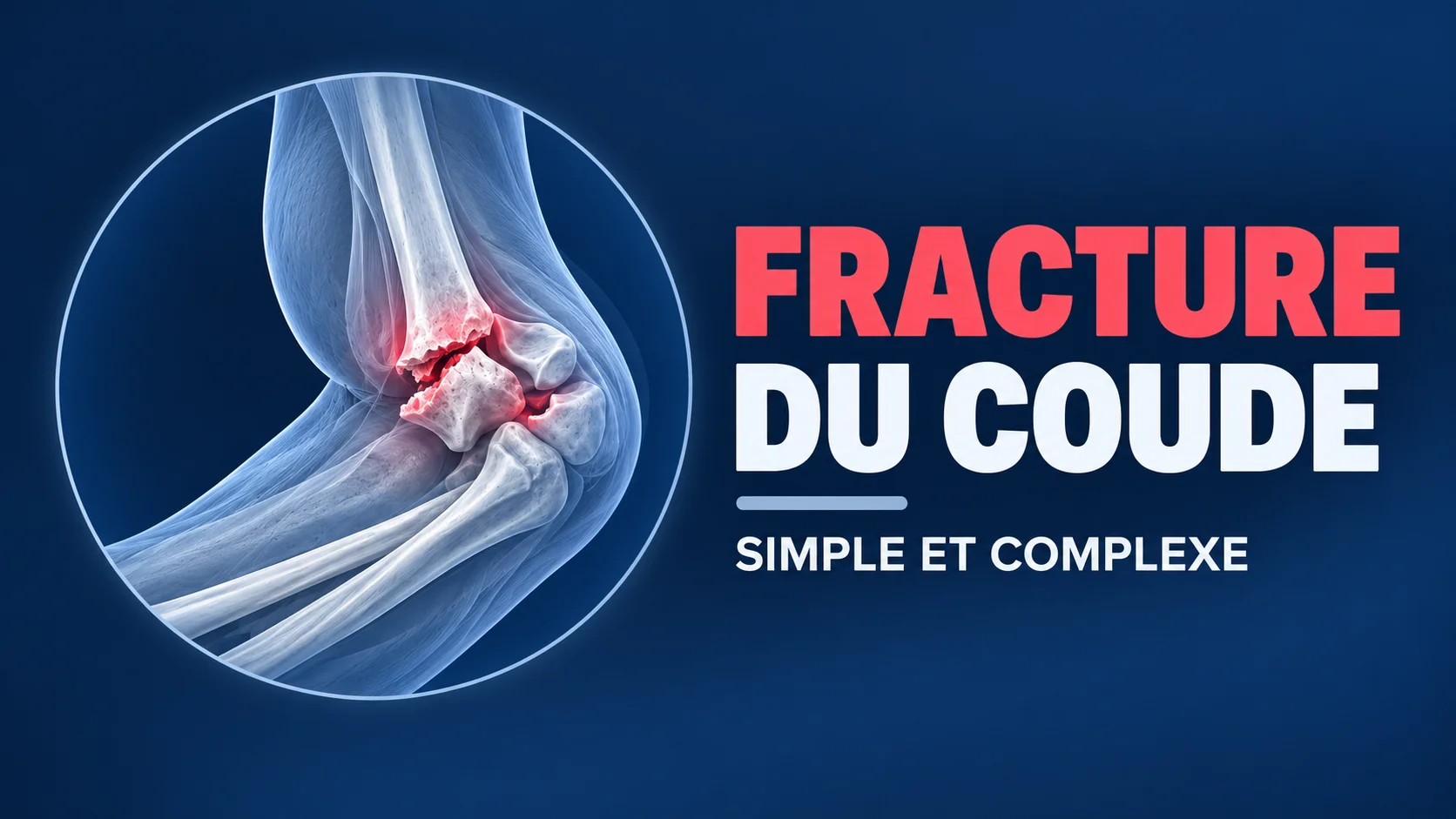 Vignette - Dr Kilinc - Fracture coude Fracture coude