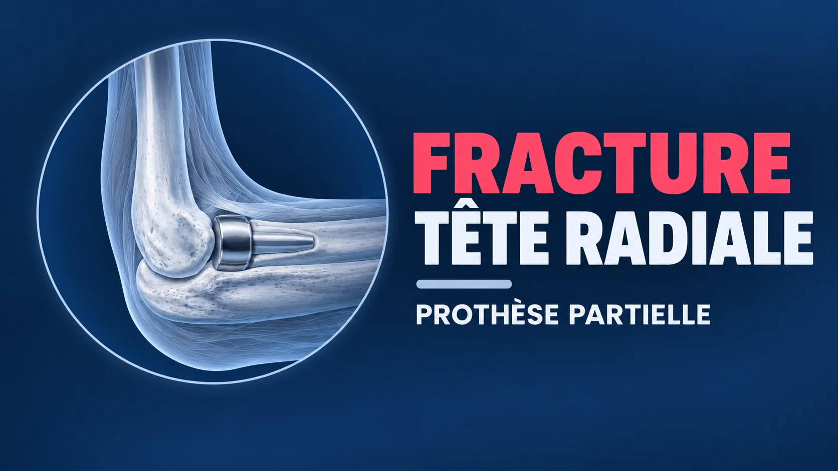Vignette - Dr Kilinc - Fracture tete radiale Fracture tête radiale