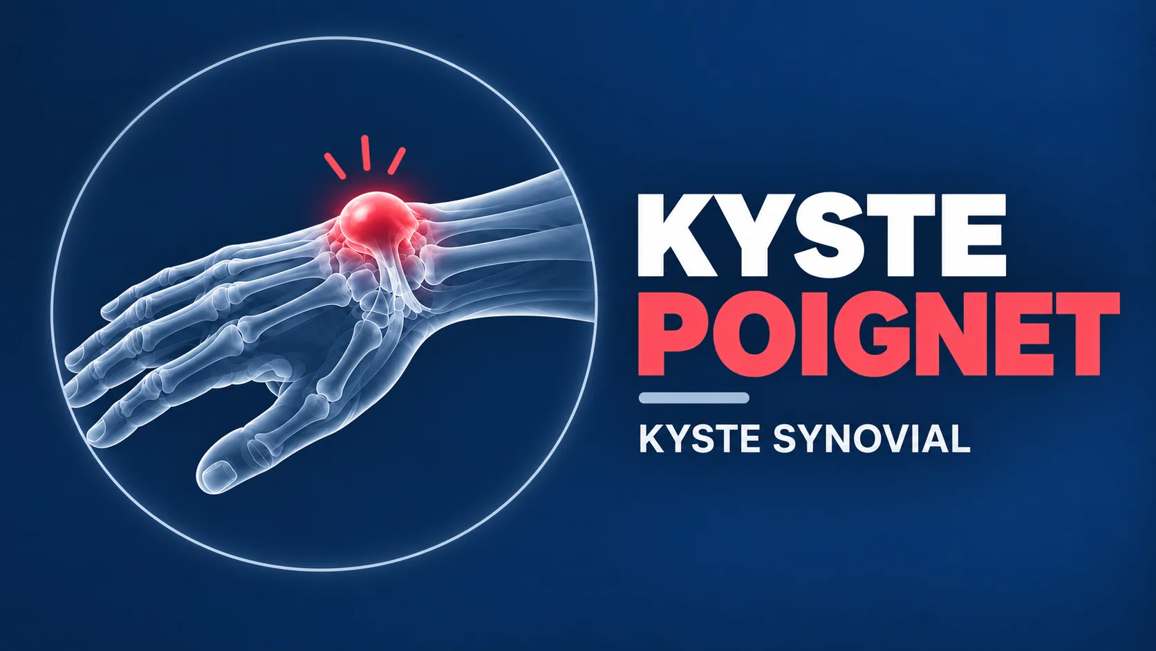 Vignette - Dr Kilinc - Kyste poignet kyste synovial