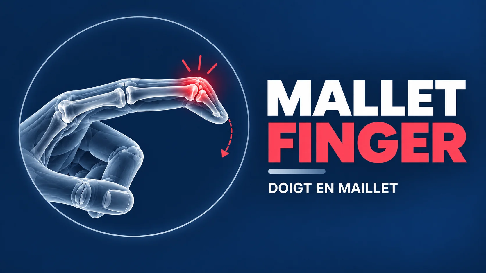 Vignette - Dr Kilinc - Mallet Finger Mallet finger
