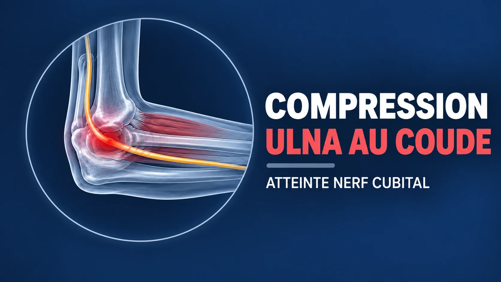 Vignette - Dr Kilinc - Nerf Cubital Ulnaire coude Compression nerf cubital au coude
