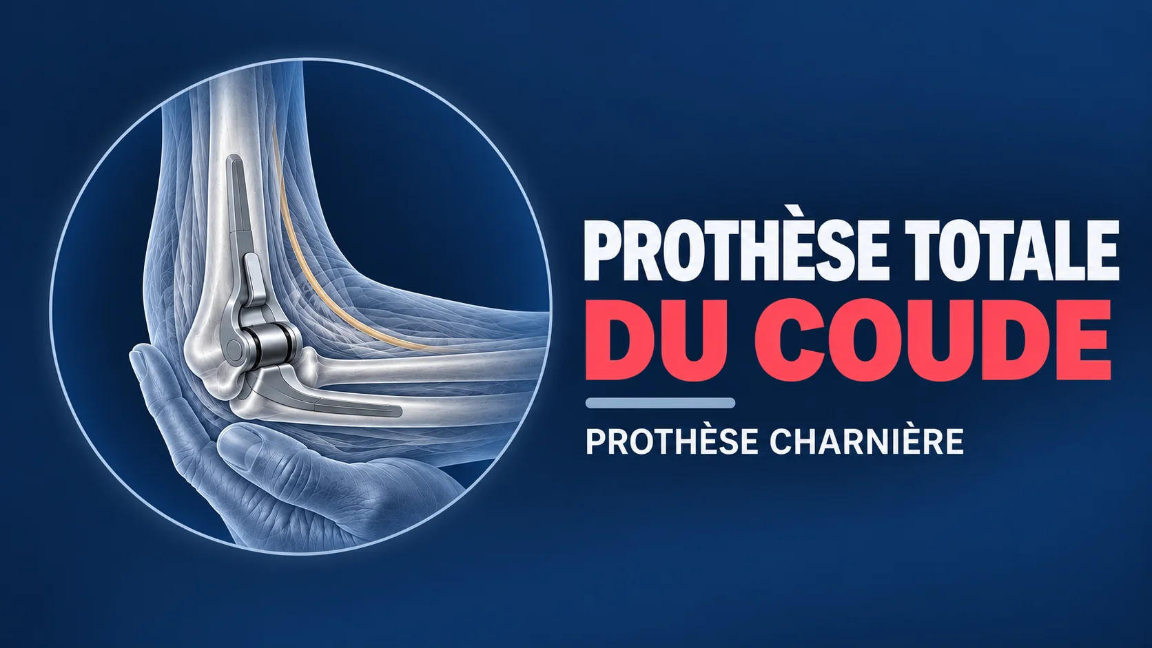 Vignette - Dr Kilinc - Prothèse totale coude Prothèse totale du coude