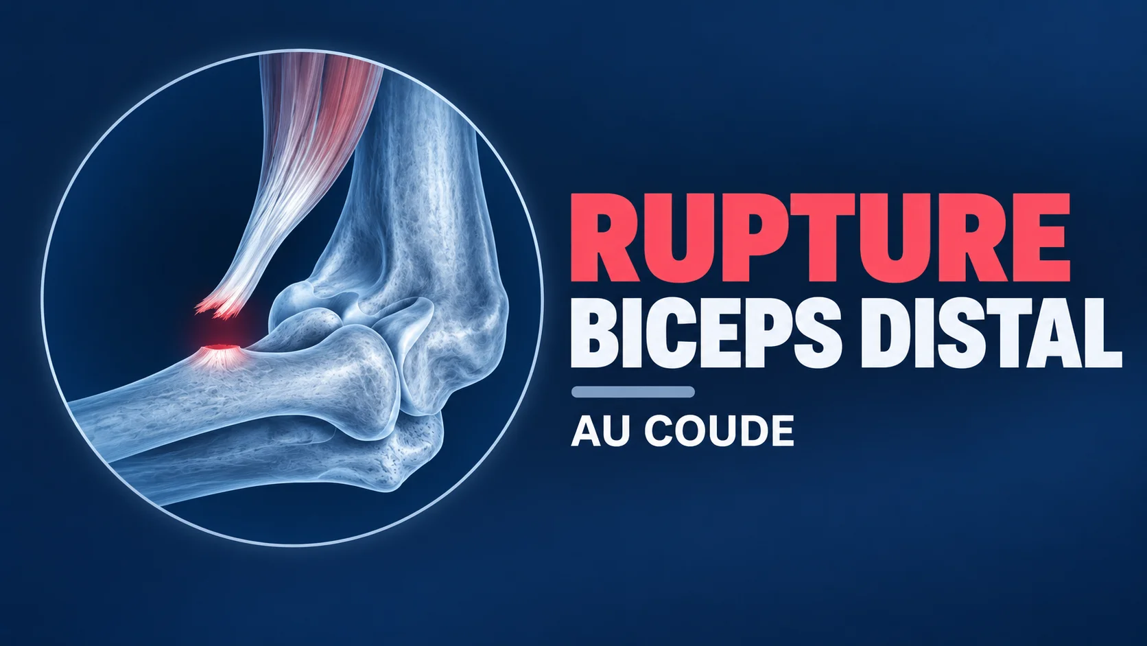 Vignette - Dr Kilinc - Rupture biceps Rupture biceps distal