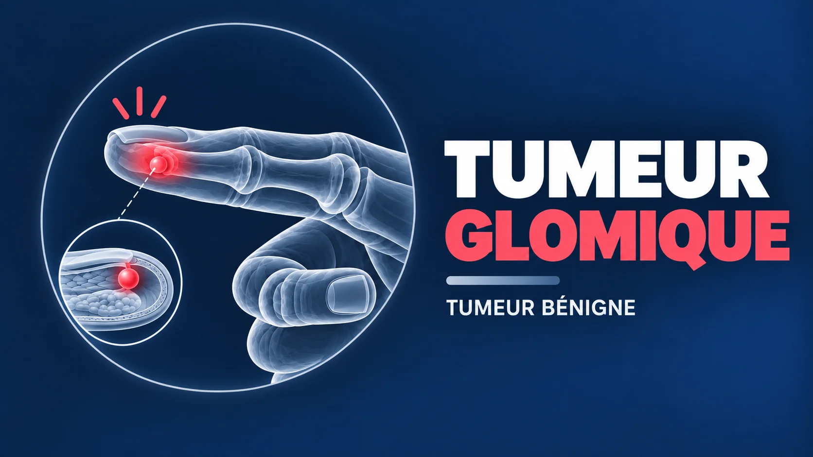 Vignette - Dr Kilinc - Tumeur Glomique Tumeur gloimique doigt