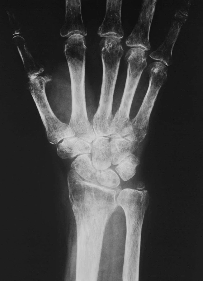 Radiographie de face du poignet et de la main : déminéralisation mouchetée juxta-articulaire du carpe et des têtes métacarpiennes, interlignes conservés, évocatrice d’algodystrophie