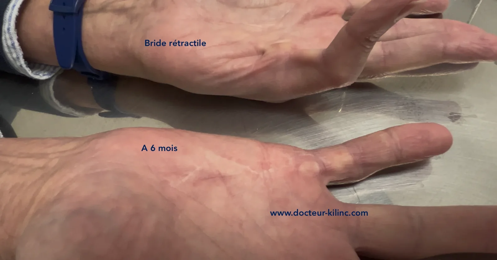 Avant / après : bride rétractile avant l'intervention, puis doigt en extension et cicatrice à 6 mois d'une aponévrectomie (patient du Dr Kilinc). Maladie de Dupuytren avant et après aponévrectomie : bride rétractile de la paume puis doigt en extension et cicatrice à 6 mois