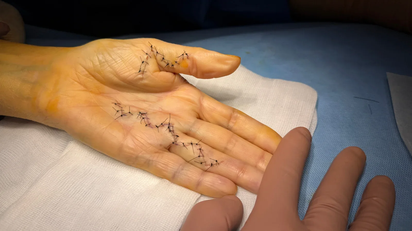 Fin d'intervention : fermeture cutanée en zigzag de la paume et du pouce (patient du Dr Kilinc). Aponévrectomie pour maladie de Dupuytren : fermeture cutanée en zigzag de la paume et du pouce en fin d'intervention