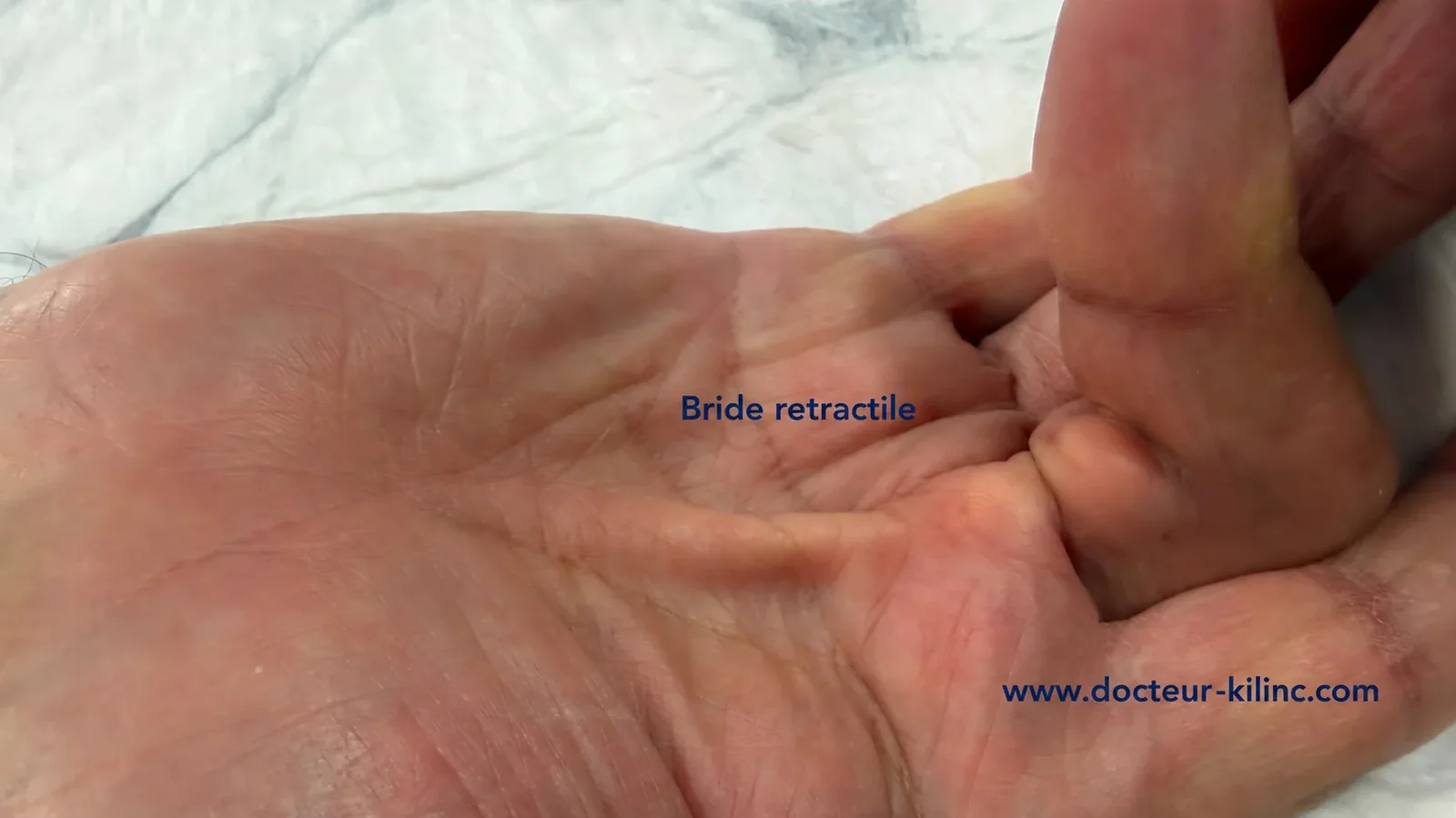 Bride rétractile de l'aponévrose palmaire tirant le doigt en flexion (patient du Dr Kilinc). Maladie de Dupuytren : bride rétractile de l'aponévrose palmaire tirant le doigt en flexion vers la paume