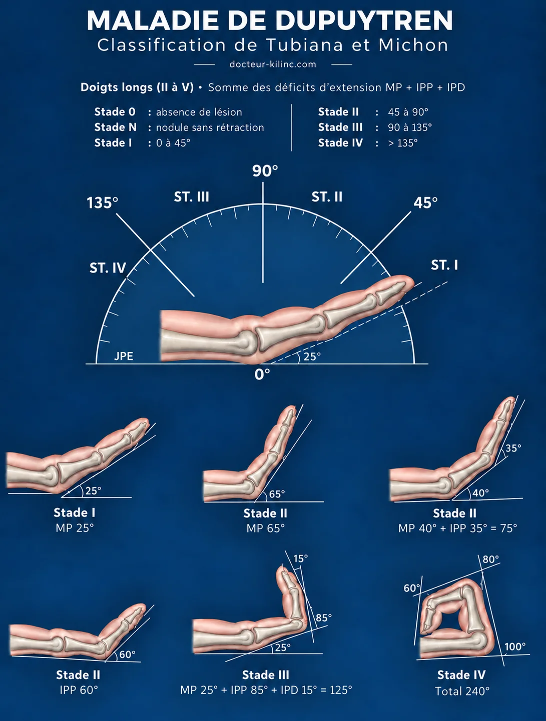Classification de Tubiana et Michon : somme des déficits d'extension MP + IPP + IPD, avec exemples cliniques (illustration Dr Kilinc). Classification de Tubiana et Michon de la maladie de Dupuytren : stades 0, N, I à IV selon la somme des déficits d'extension MP, IPP et IPD