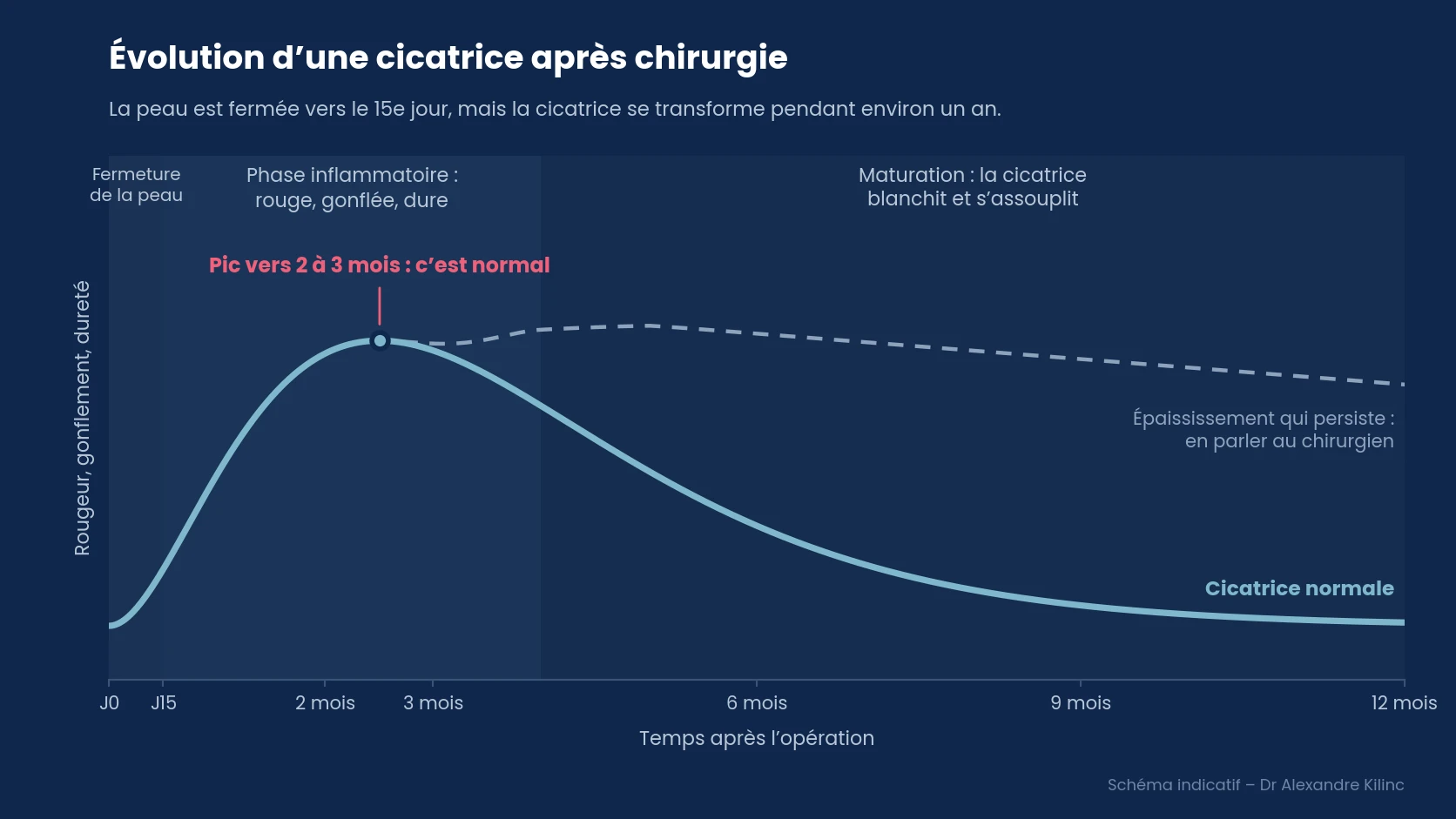 Évolution d’une cicatrice après chirurgie Courbe d’évolution d’une cicatrice après chirurgie : rougeur, gonflement et dureté maximaux vers 2 à 3 mois, puis amélioration progressive jusqu’à 1 an