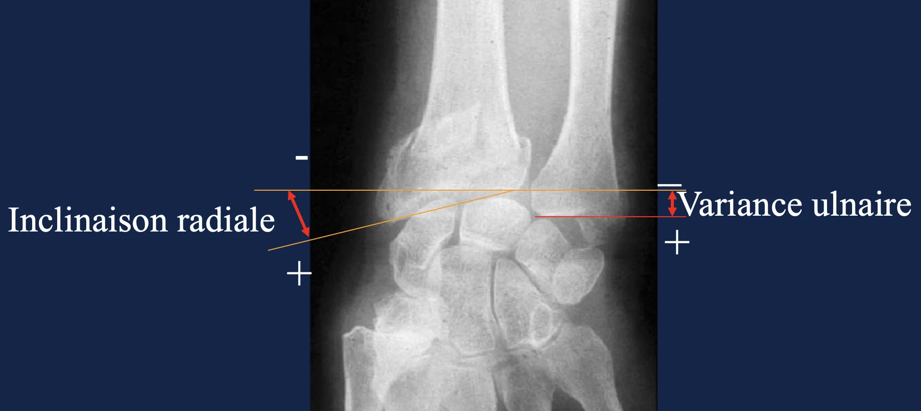 Radiographie de face : inclinaison radiale et variance ulnaire Radiographie de face d’une fracture du poignet : mesure de l’inclinaison radiale et de la variance ulnaire
