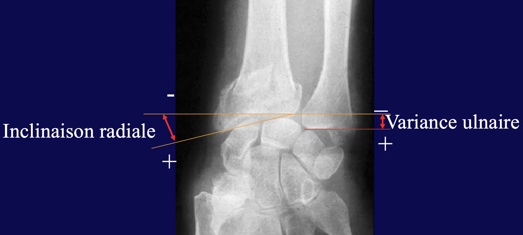 Radiographie de face : inclinaison radiale et variance ulnaire Radiographie de face d’une fracture du poignet : mesure de l’inclinaison radiale et de la variance ulnaire