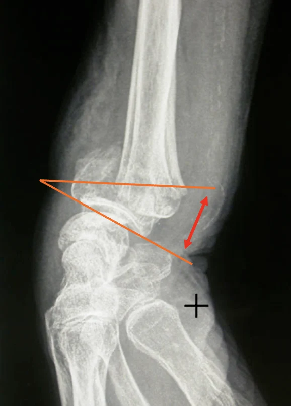 Radiographie de profil : mesure de la bascule dorsale Radiographie de profil d’une fracture du poignet : mesure de la bascule dorsale de la surface articulaire du radius