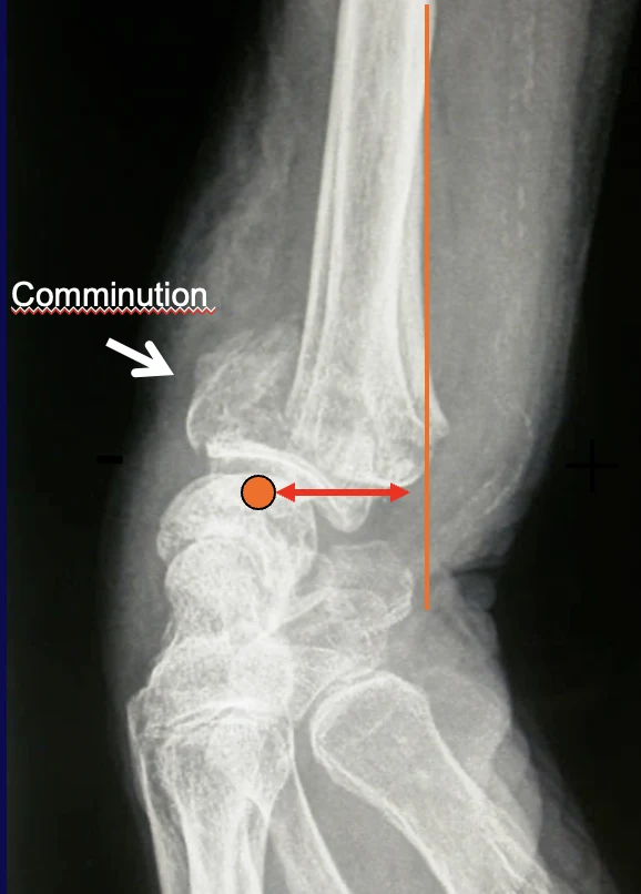 Radiographie de profil : comminution dorsale et translation du carpe Radiographie de profil d’une fracture du poignet : comminution dorsale et translation du carpe vers l’arrière