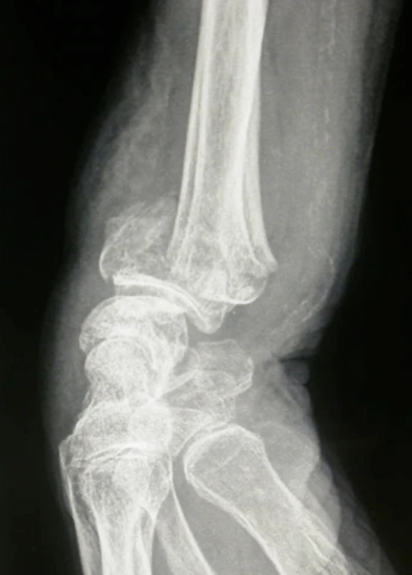 Radiographie de profil : fracture de Pouteau-Colles Radiographie de profil d’une fracture de Pouteau-Colles du poignet avec bascule dorsale