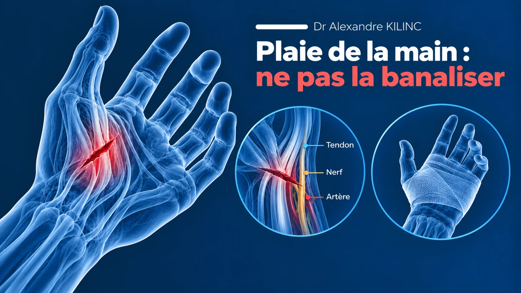 Plaie avec section d'un tendon fléchisseur de la main et perte de flexion du doigt