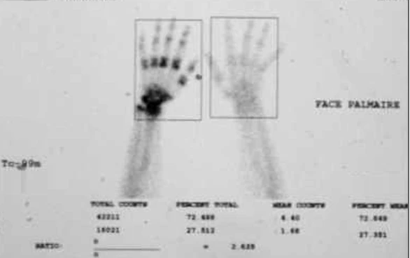 Scintigraphie osseuse des mains, temps tardif : hyperfixation diffuse à renforcement péri-articulaire de la main atteinte comparée au côté sain