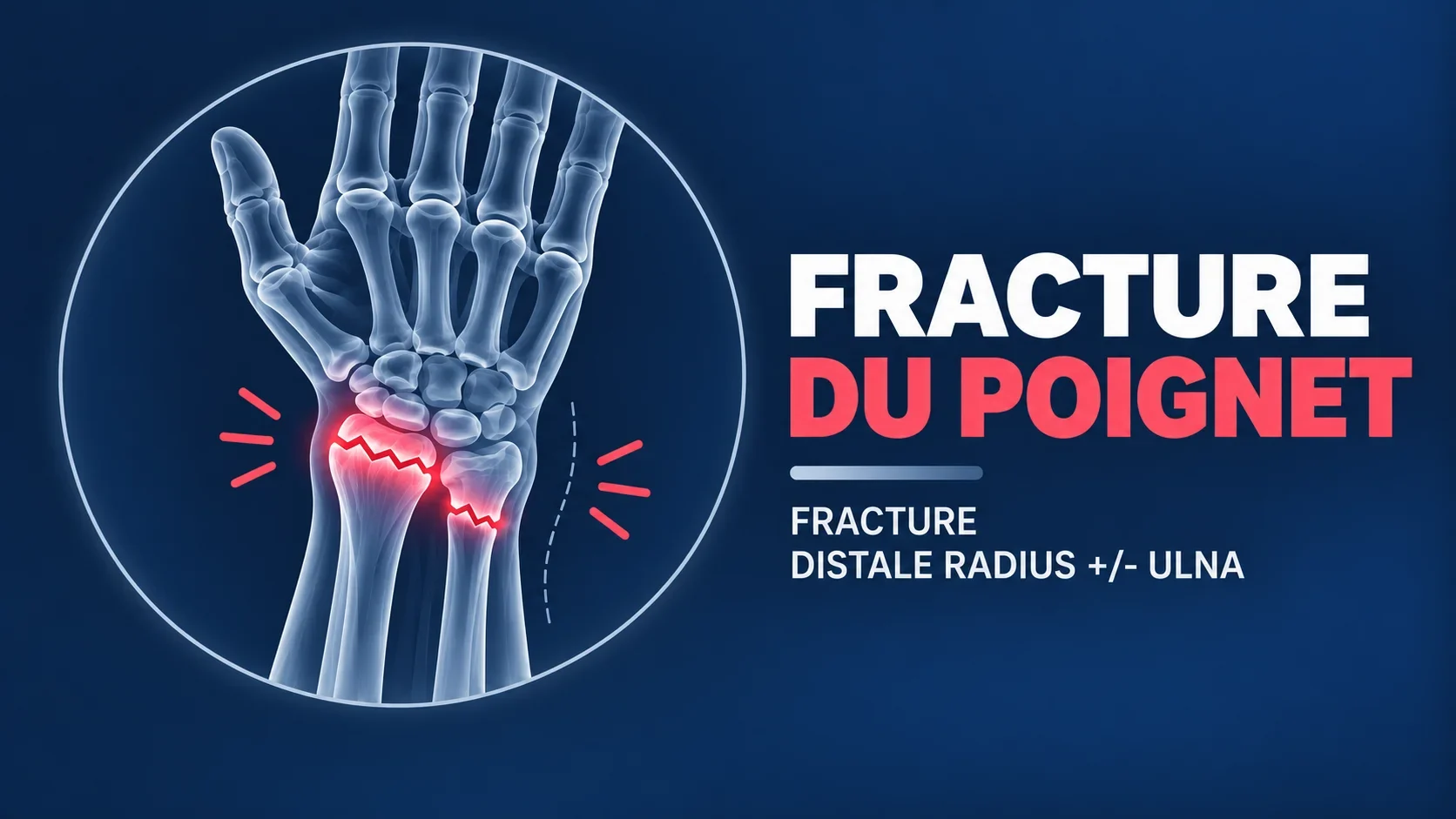 Fracture du poignet : fracture de l’extrémité distale du radius, avec ou sans fracture de l’ulna