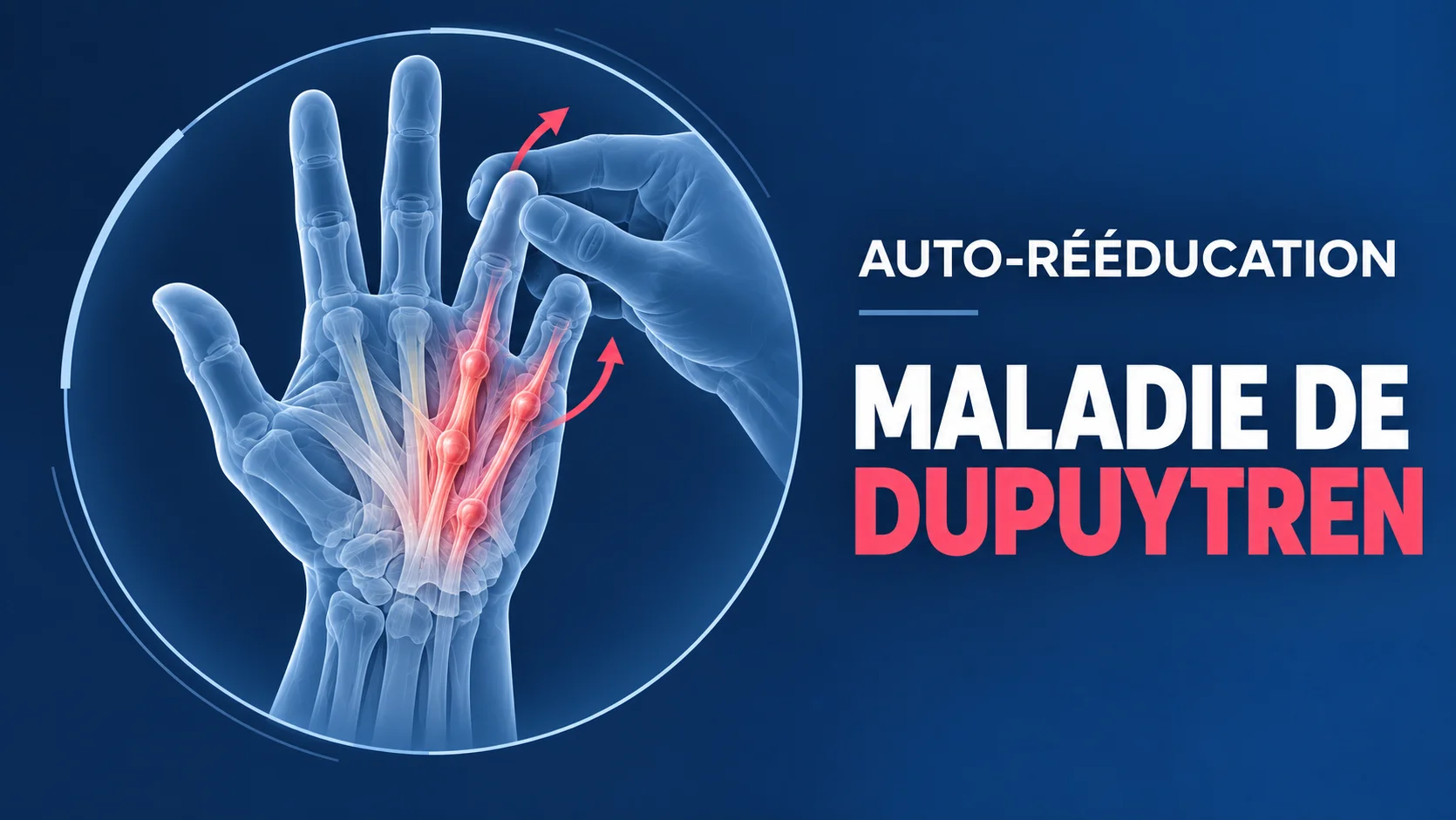 Vignette - Dr Kilinc - Auto-rééducation Dupuytren Auto-rééducation après opération de la maladie de Dupuytren : exercices d’extension des doigts