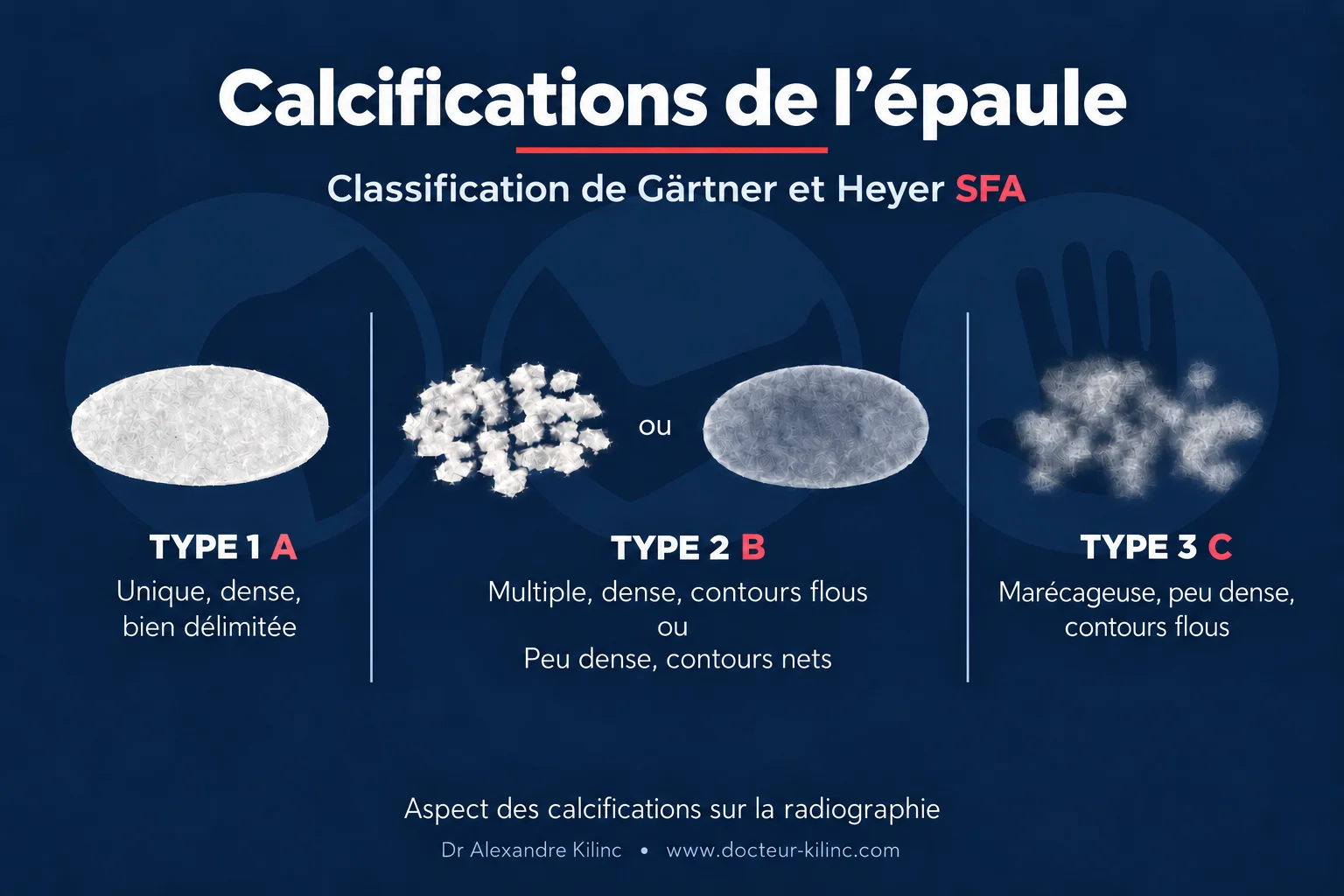 Calcifications de l’épaule — classification de Gärtner et Heyer Classification radiographique des calcifications de l’épaule (Gärtner et Heyer) : type A dense et bien délimitée, type B, type C peu dense à contours flous