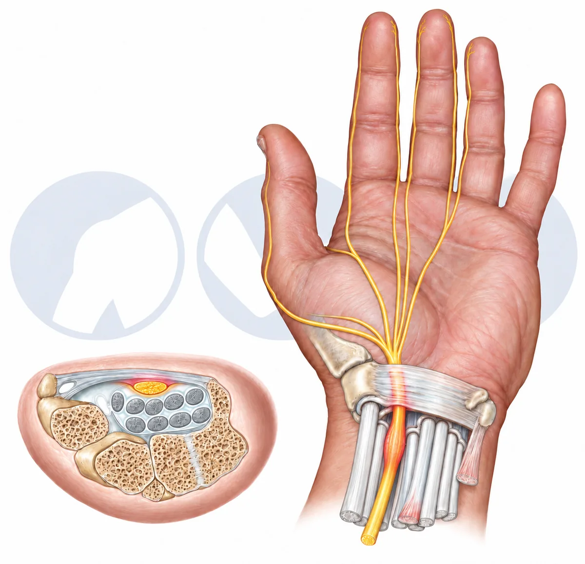 Compression du nerf médian dans le canal carpien Syndrome du canal carpien : compression du nerf médian sous le ligament annulaire du carpe, nerf aplati et inflammatoire (vue palmaire et coupe du poignet)