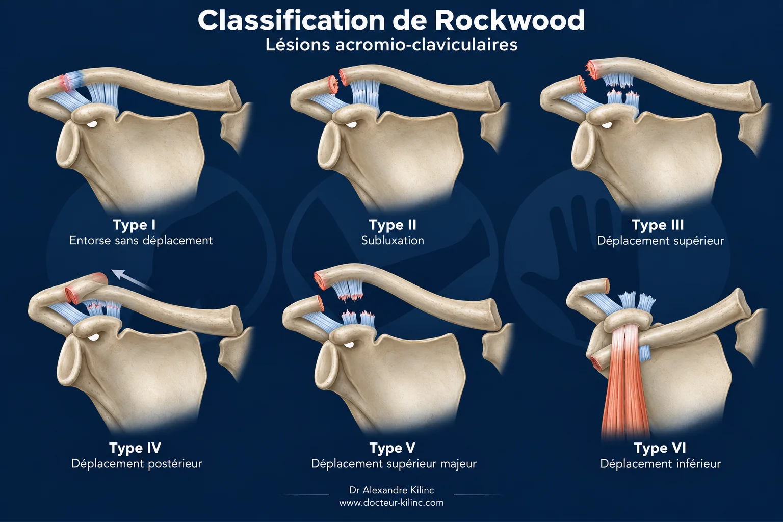 Classification de Rockwood — disjonction acromio-claviculaire Classification de Rockwood des disjonctions acromio-claviculaires : types I à VI selon le déplacement de la clavicule