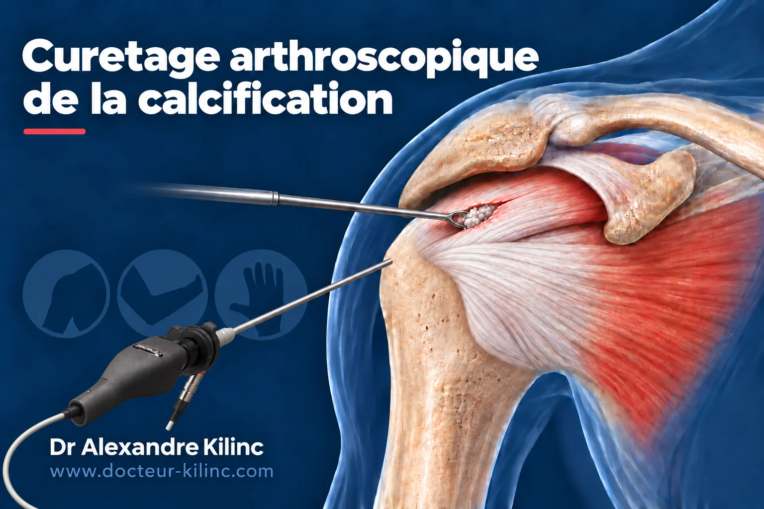 Curetage arthroscopique de la calcification de l’épaule Curetage arthroscopique d’une tendinite calcifiante de l’épaule : arthroscope et instrument évacuant la calcification du tendon supra-épineux
