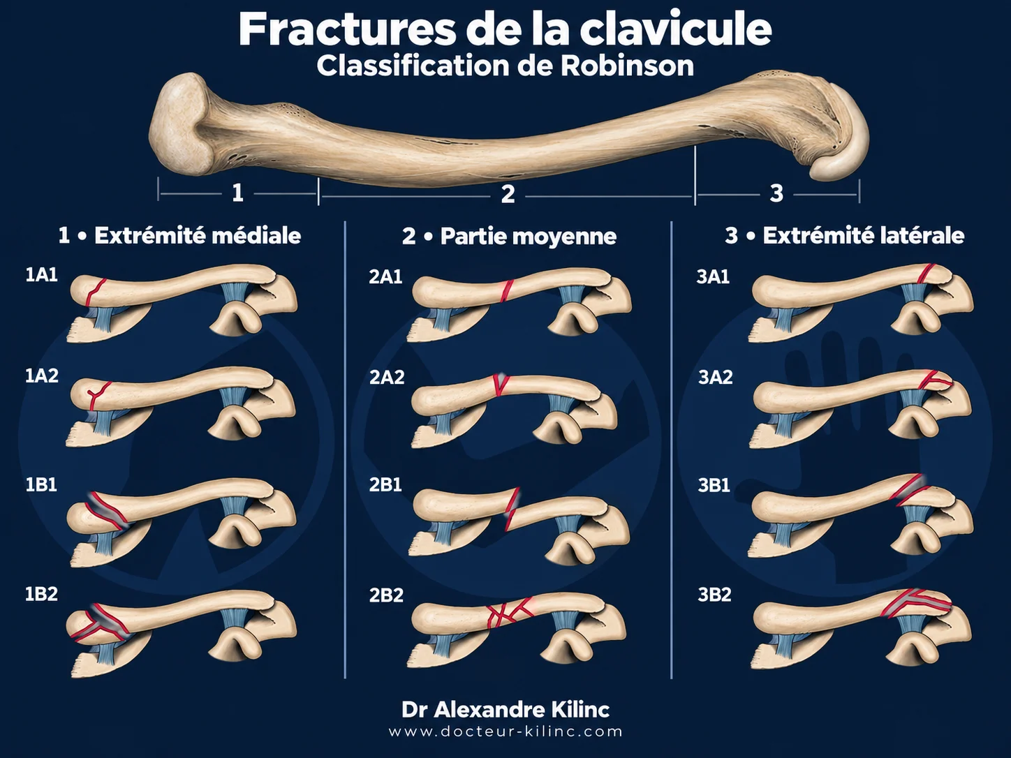 Fractures de la clavicule — classification de Robinson Classification de Robinson des fractures de la clavicule : extrémité médiale, partie moyenne et extrémité latérale