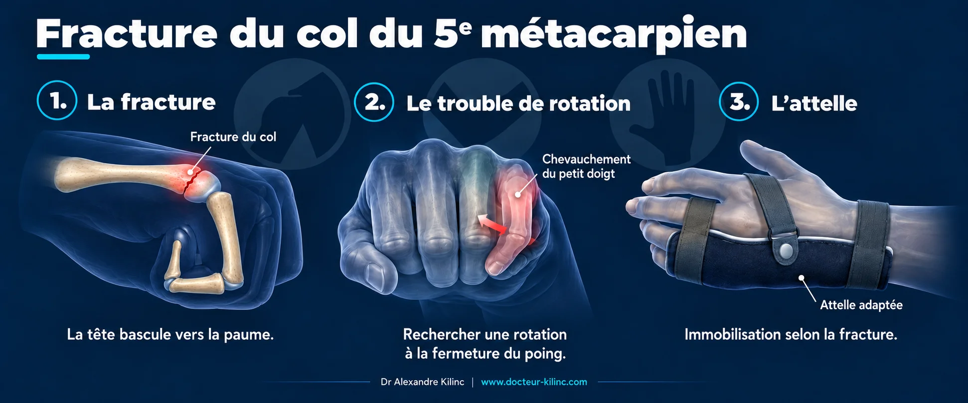 fracture-col-5e-metacarpien-rotation-attelle Fracture du col du 5e métacarpien en trois étapes : bascule de la tête vers la paume, recherche d'un chevauchement du petit doigt à la fermeture du poing, immobilisation par attelle