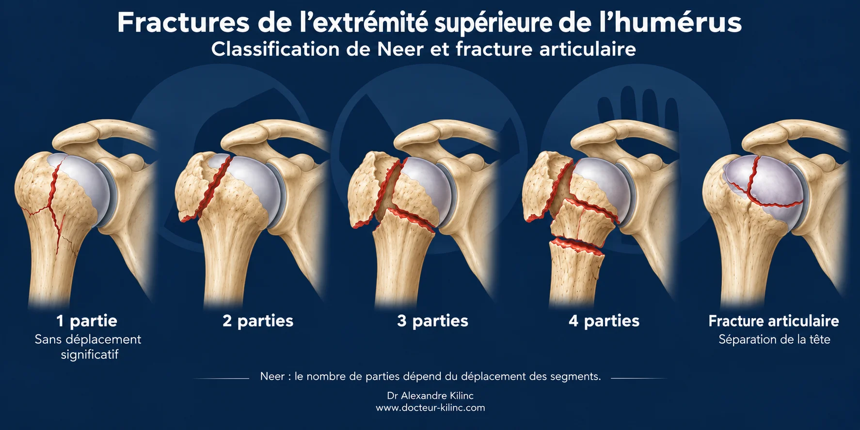 Fractures de l’humérus proximal — classification de Neer Classification de Neer des fractures de l’extrémité supérieure de l’humérus : 1 à 4 parties et fracture articulaire
