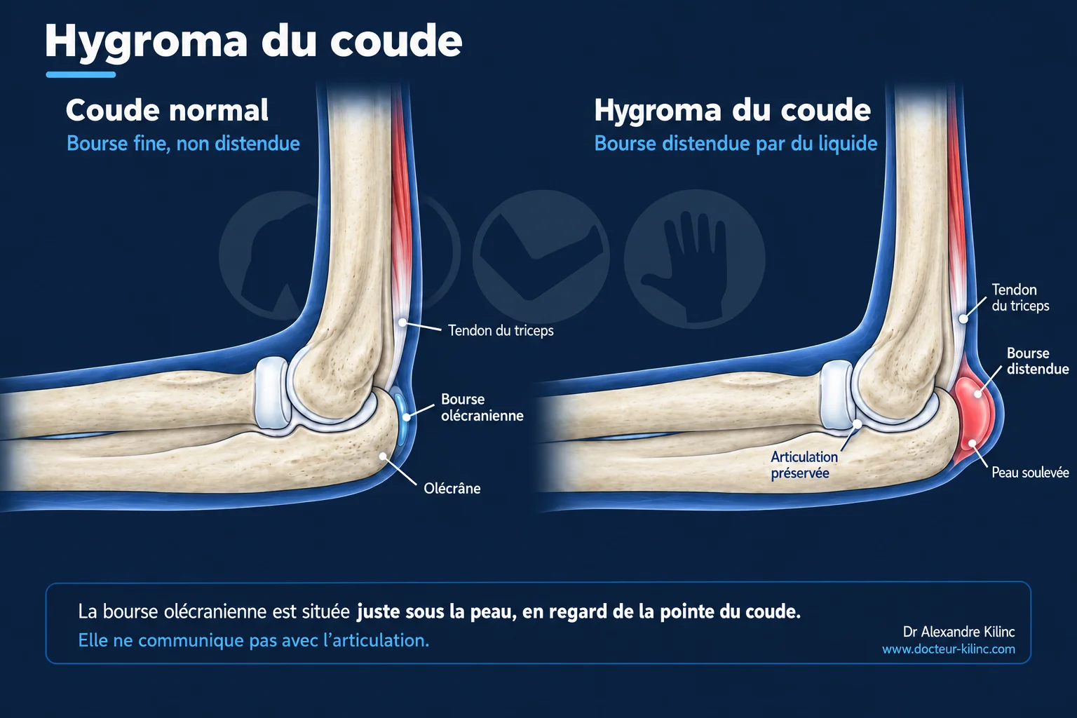 Hygroma du coude — anatomie de la bourse séreuse olécranienne Schéma d'un hygroma du coude : bourse séreuse olécranienne distendue sous la peau, en regard de l'olécrane