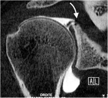 Lésion SLAP – arthroscanner de l’épaule Arthroscanner de l’épaule droite en coupe coronale : produit de contraste infiltrant la base du labrum supérieur (flèche), évocateur d’une lésion SLAP