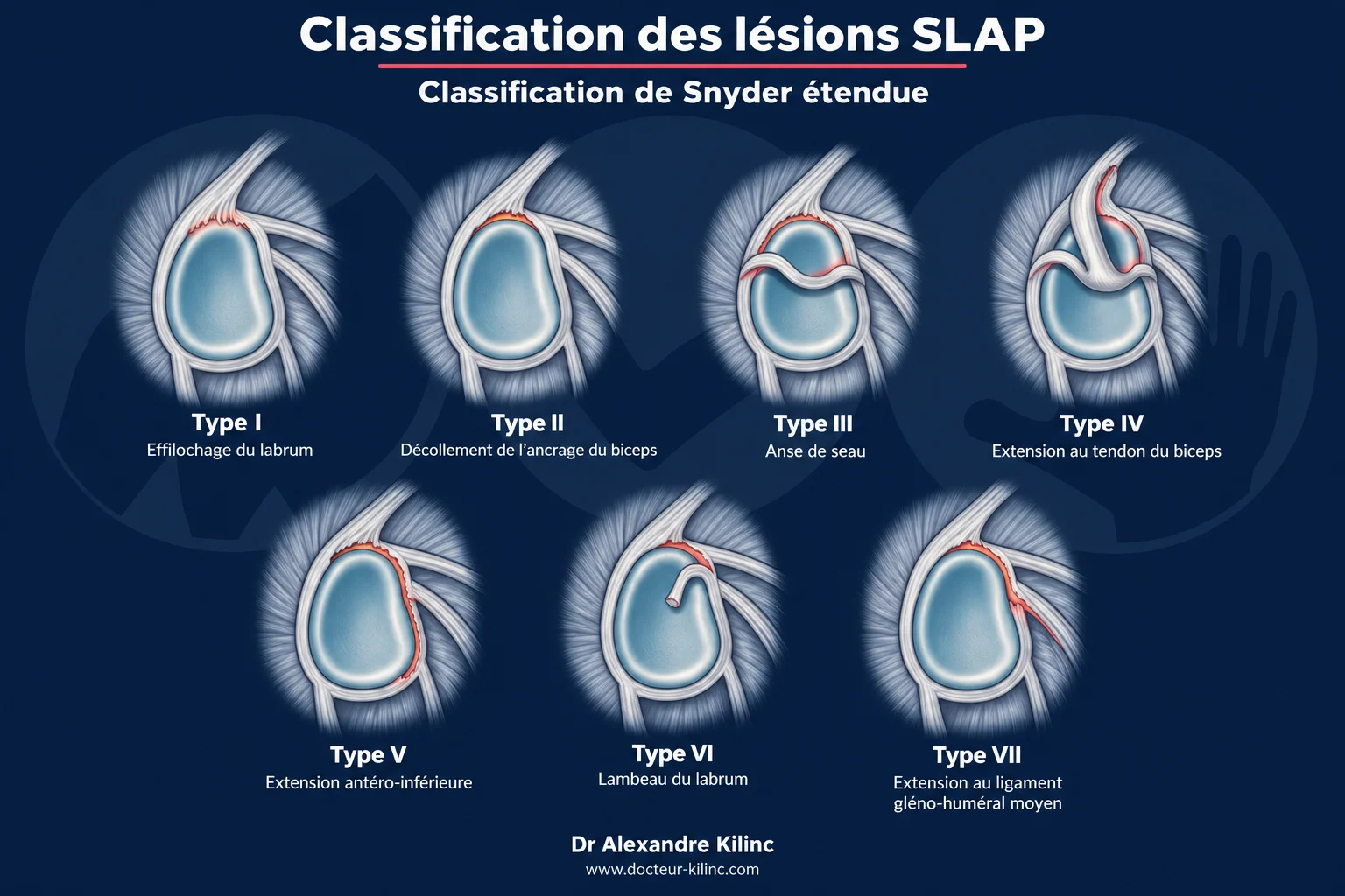 Lésions SLAP — classification de Snyder étendue Classification de Snyder étendue des lésions SLAP de l’épaule : types I à VII du labrum supérieur et du long biceps
