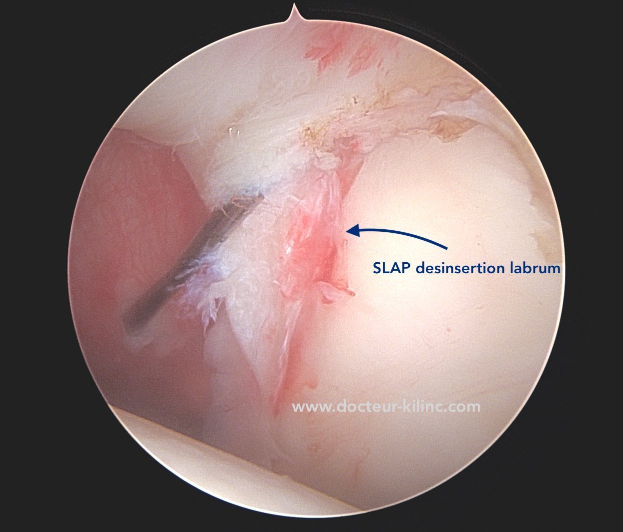 Lésion SLAP type II – vue arthroscopique Vue arthroscopique de l’épaule : lésion SLAP type II avec désinsertion du labrum supérieur
