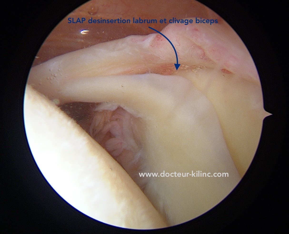 Lésion SLAP type IV – vue arthroscopique Vue arthroscopique de l’épaule : lésion SLAP type IV avec désinsertion du labrum et clivage du long biceps
